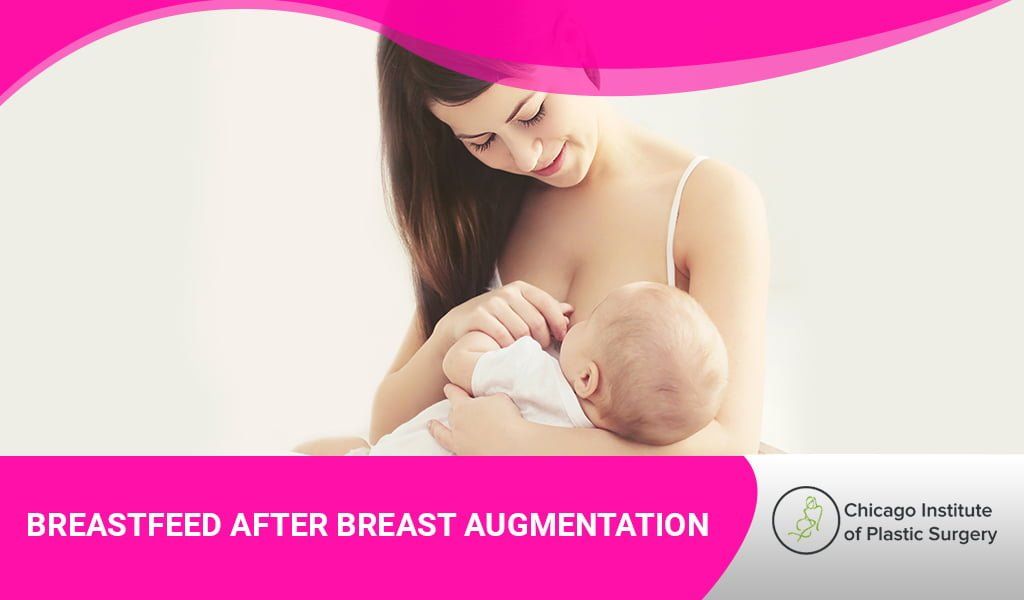 Can You Breastfeed After Breast Augmentation